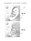 Transcutaneous Electrostimulator and Methods for Electric Stimulation diagram and image