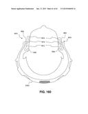 Transcutaneous Electrostimulator and Methods for Electric Stimulation diagram and image