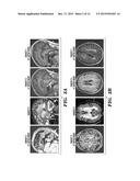 METHODS AND ASSAYS RELATING TO RNF216 diagram and image