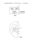 Physiological Monitoring Devices Having Sensing Elements Decoupled from     Body Motion diagram and image