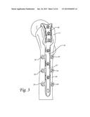 Method of Dynamically Compressing a Fracture diagram and image