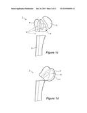 ARTICULAR FRACTURE FIXATION SYSTEM AND METHOD diagram and image