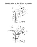ARTICULAR FRACTURE FIXATION SYSTEM AND METHOD diagram and image