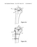 ARTICULAR FRACTURE FIXATION SYSTEM AND METHOD diagram and image