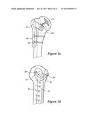 ARTICULAR FRACTURE FIXATION SYSTEM AND METHOD diagram and image