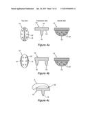 ARTICULAR FRACTURE FIXATION SYSTEM AND METHOD diagram and image