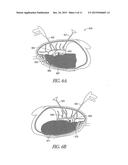 SYSTEM AND METHOD FOR BRONCHIAL DILATION diagram and image