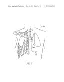 SYSTEM AND METHOD FOR BRONCHIAL DILATION diagram and image