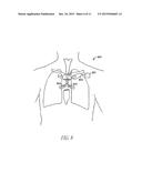 SYSTEM AND METHOD FOR BRONCHIAL DILATION diagram and image