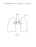 SYSTEM AND METHOD FOR BRONCHIAL DILATION diagram and image