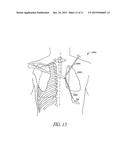 SYSTEM AND METHOD FOR BRONCHIAL DILATION diagram and image