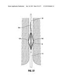 SYSTEMS AND METHODS FOR TREATING TISSUE WITH RADIOFREQUENCY ENERGY diagram and image