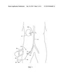 MEDICAL DEVICE FOR SYMPATHETIC NERVE ABLATION WITH PRINTED COMPONENTS diagram and image