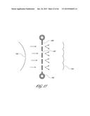 DELIVERY SYSTEM FOR INFLATABLE IMPLANT diagram and image