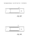 DELIVERY SYSTEM FOR INFLATABLE IMPLANT diagram and image