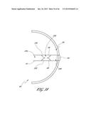 DELIVERY SYSTEM FOR INFLATABLE IMPLANT diagram and image