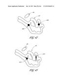 DELIVERY SYSTEM FOR INFLATABLE IMPLANT diagram and image