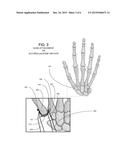 SURGICAL IMPLANTABLE STABILIZER SLING FOR BASAL JOINT ARTHROPLASTY diagram and image