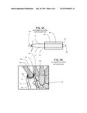 SURGICAL IMPLANTABLE STABILIZER SLING FOR BASAL JOINT ARTHROPLASTY diagram and image