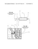 SURGICAL IMPLANTABLE STABILIZER SLING FOR BASAL JOINT ARTHROPLASTY diagram and image