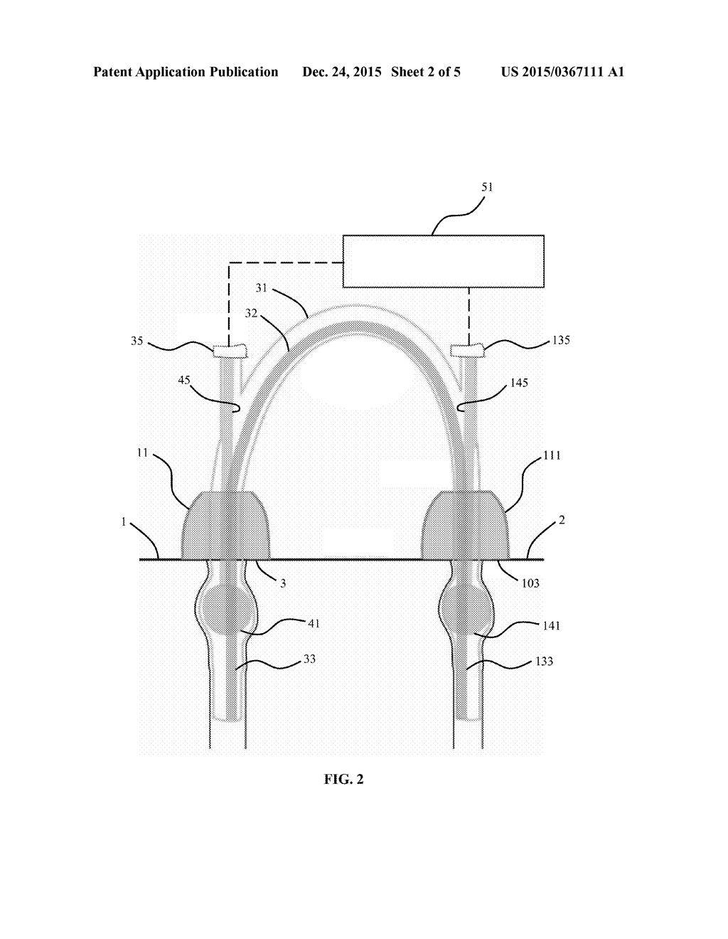 Ostomy Pump System and Related Methods of Use and Manufacture - diagram, schematic, and image 03