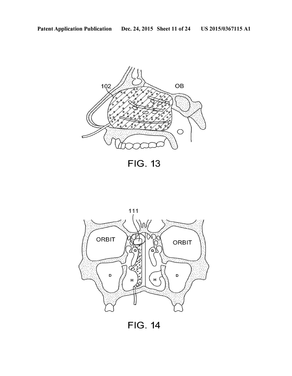 METHODS AND SYSTEMS FOR TOXIN DELIVERY TO THE NASAL CAVITY - diagram, schematic, and image 12