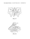 METHODS AND SYSTEMS FOR TOXIN DELIVERY TO THE NASAL CAVITY diagram and image