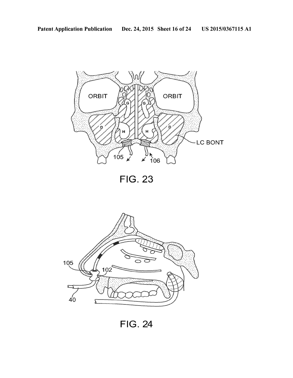 METHODS AND SYSTEMS FOR TOXIN DELIVERY TO THE NASAL CAVITY - diagram, schematic, and image 17