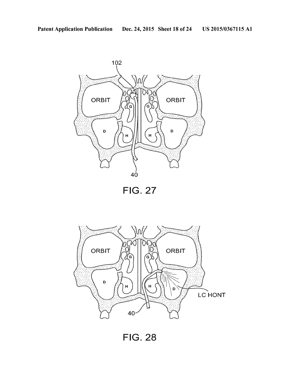 METHODS AND SYSTEMS FOR TOXIN DELIVERY TO THE NASAL CAVITY - diagram, schematic, and image 19