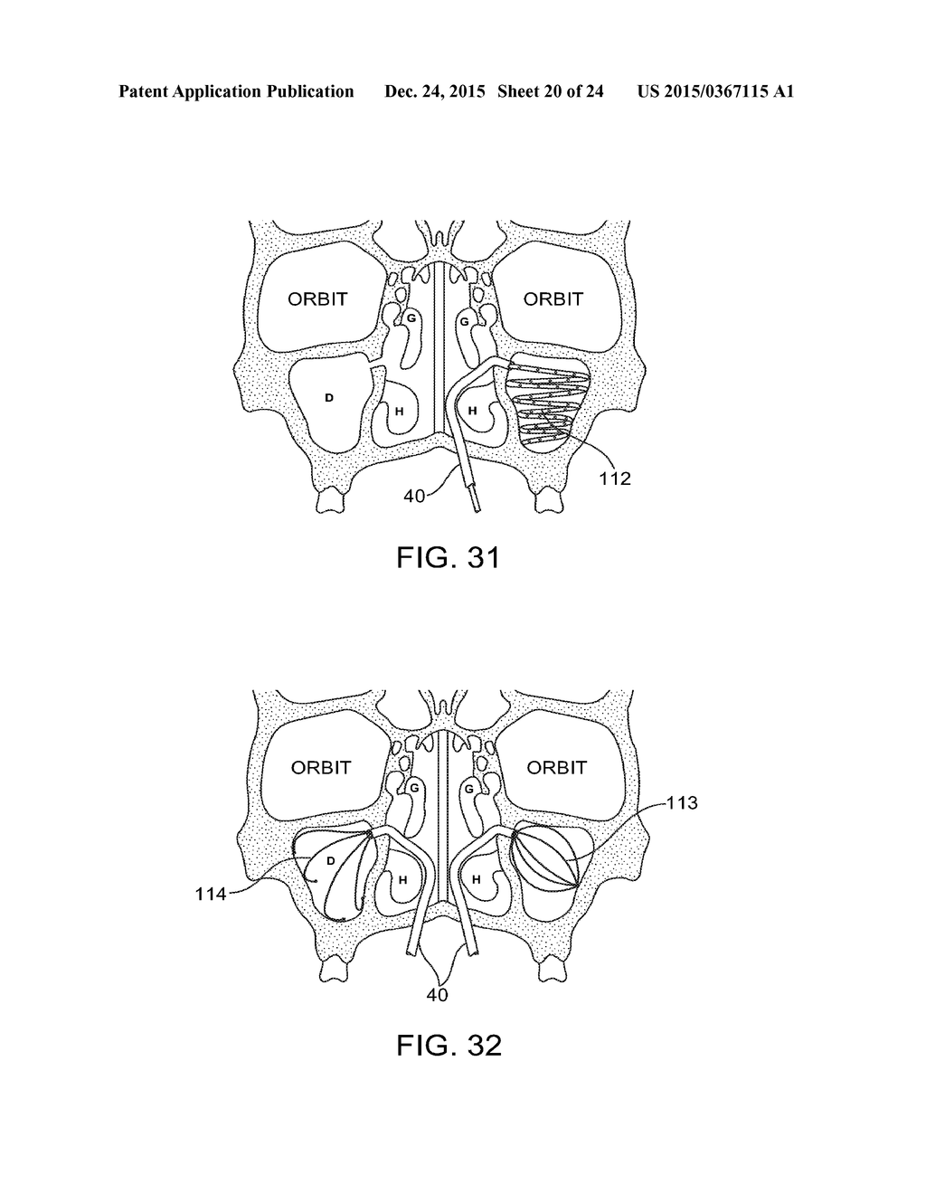 METHODS AND SYSTEMS FOR TOXIN DELIVERY TO THE NASAL CAVITY - diagram, schematic, and image 21