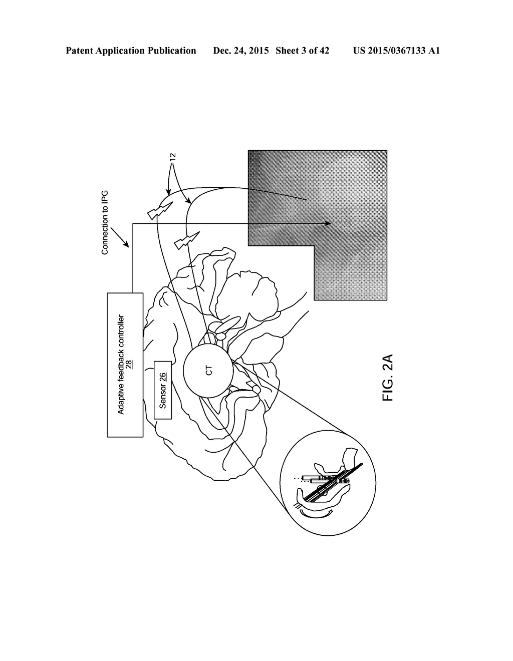 SYSTEM AND METHODS FOR MULTI-SITE ACTIVATION OF THE THALAMUS - diagram, schematic, and image 04