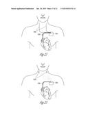 AUTONOMIC MODULATION USING TRANSIENT RESPONSE WITH INTERMITTENT NEURAL     STIMULATION diagram and image