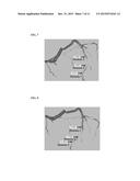 Method and System for Prediction of Post-Stenting Hemodynamic Metrics for     Treatment Planning of Arterial Stenosis diagram and image