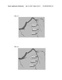 Method and System for Prediction of Post-Stenting Hemodynamic Metrics for     Treatment Planning of Arterial Stenosis diagram and image