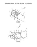 Flexible high-density mapping catheter tips and flexible ablation catheter     tips with onboard high-density mapping electrodes diagram and image