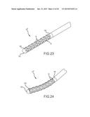 Flexible high-density mapping catheter tips and flexible ablation catheter     tips with onboard high-density mapping electrodes diagram and image