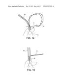 METHODS OF MAKING REINFORCED SOFT TISSUE GRAFTS WITH SUTURE LOOP/NEEDLE     CONSTRUCTS diagram and image