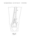 CUSTOMIZED PATIENT-SPECIFIC REVISION SURGICAL INSTRUMENTS AND METHOD diagram and image