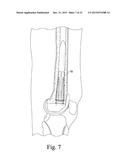 CUSTOMIZED PATIENT-SPECIFIC REVISION SURGICAL INSTRUMENTS AND METHOD diagram and image