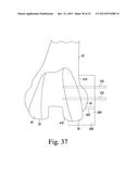 CUSTOMIZED PATIENT-SPECIFIC REVISION SURGICAL INSTRUMENTS AND METHOD diagram and image