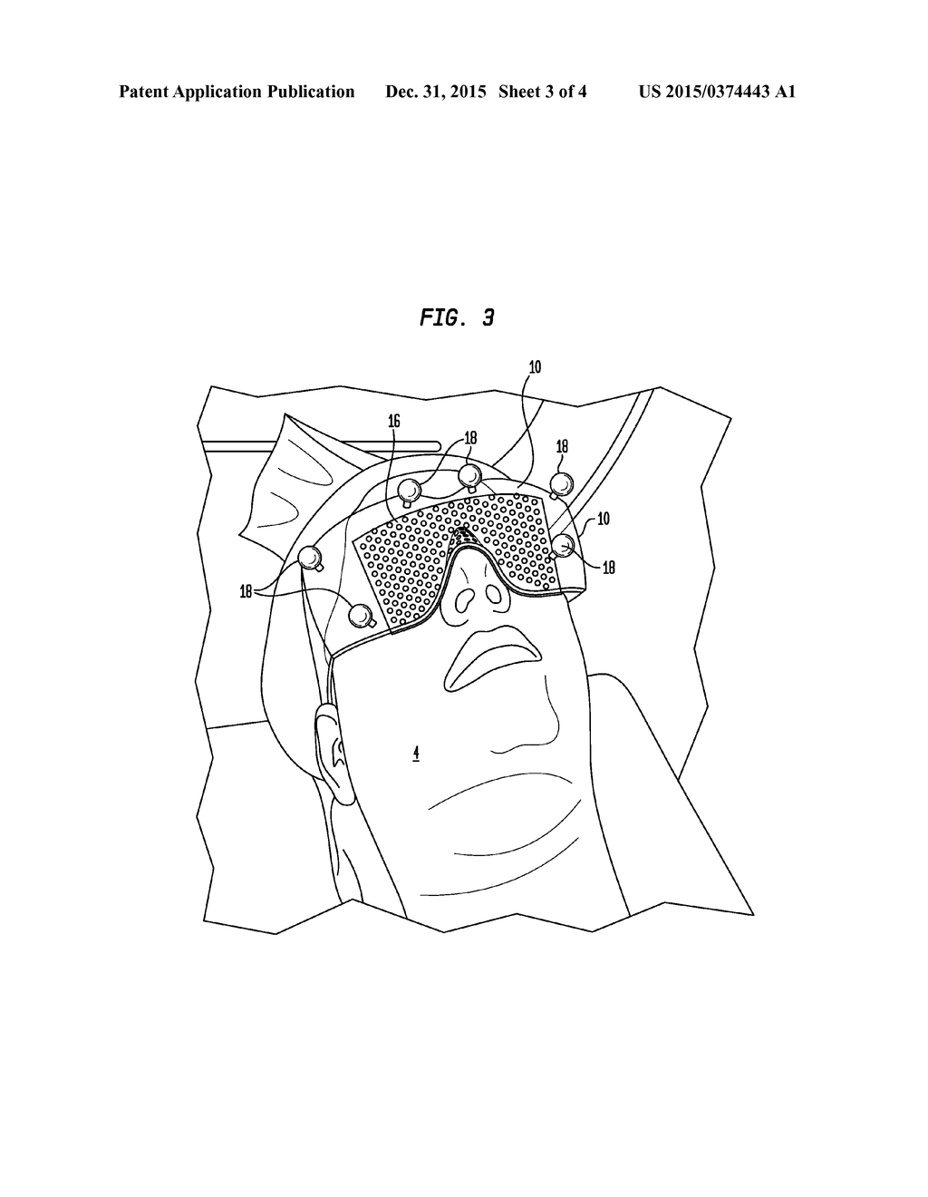 CRANIAL ALIGNMENT DEVICE FOR USE IN INTRACRANIAL STEREOTACTIC SURGERY - diagram, schematic, and image 04