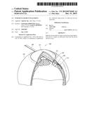 INTRAOCULAR SHUNT PLACEMENT diagram and image