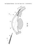 INTRAOCULAR SHUNT PLACEMENT diagram and image