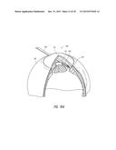 INTRAOCULAR SHUNT PLACEMENT diagram and image