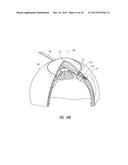 INTRAOCULAR SHUNT PLACEMENT diagram and image