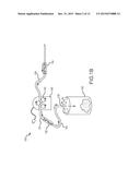 TISSUE PARCELIZATION METHOD AND APPARATUS diagram and image