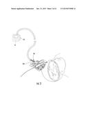 MRI-Compatible Surgical Cannulae for Transferring a Substance to and/or     from a Patient diagram and image