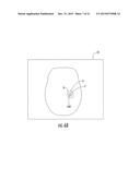 MRI-Compatible Surgical Cannulae for Transferring a Substance to and/or     from a Patient diagram and image