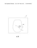 MRI-Compatible Surgical Cannulae for Transferring a Substance to and/or     from a Patient diagram and image