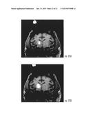 MRI-Compatible Surgical Cannulae for Transferring a Substance to and/or     from a Patient diagram and image